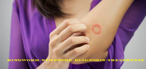 ringworm-symptoms-diagnosis-treatments