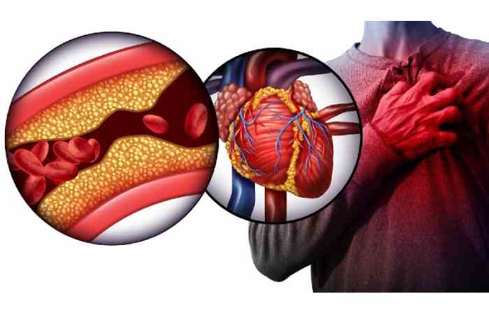 Cardiovascular Disease