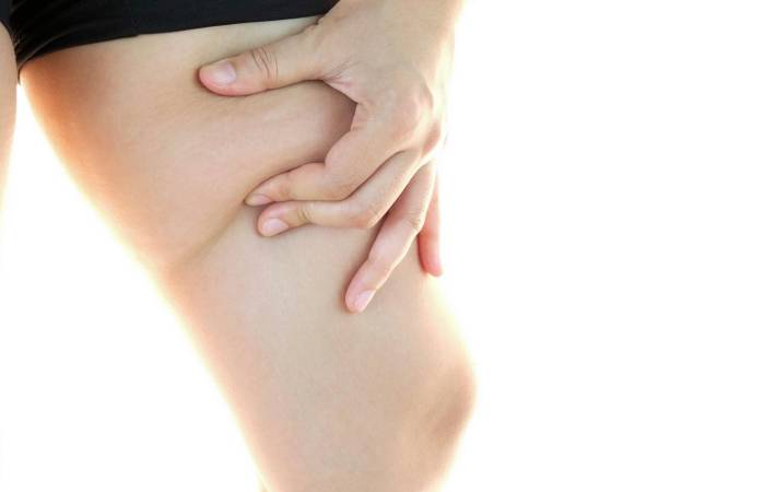 liposuction 