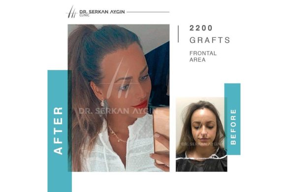 The Dr. Serkan Aygin Clinic Assists Women with Hair Transplantation