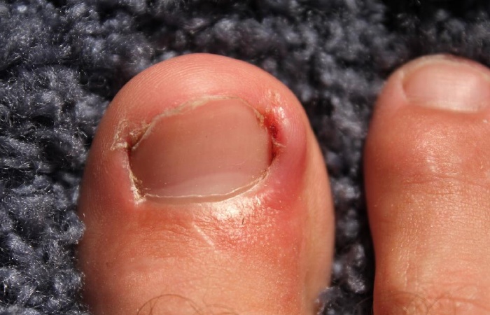 Ingrown Toenail Treatment