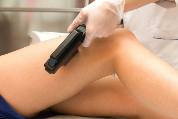 The Pros and Cons of Laser Hair Removal for Hands