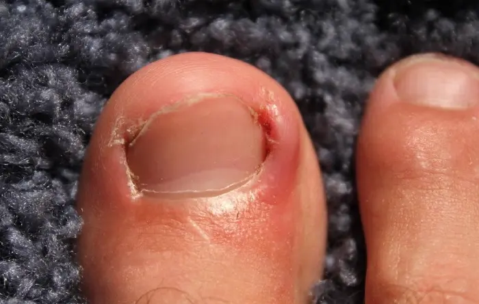 Ingrown Toenail Treatment