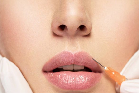 Lip Flip with Botox