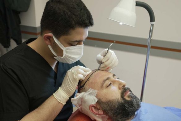 Hair transplant in Turkey - Cosmedica Clinic